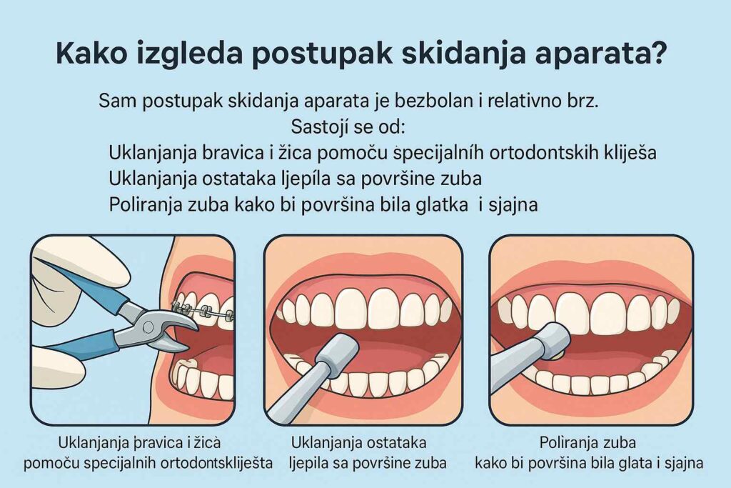 ilustracija koja pokazuje proces skidanja aparatića za zube