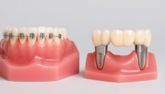 razlika između fiksnog zubnog aparata i fiksne proteze